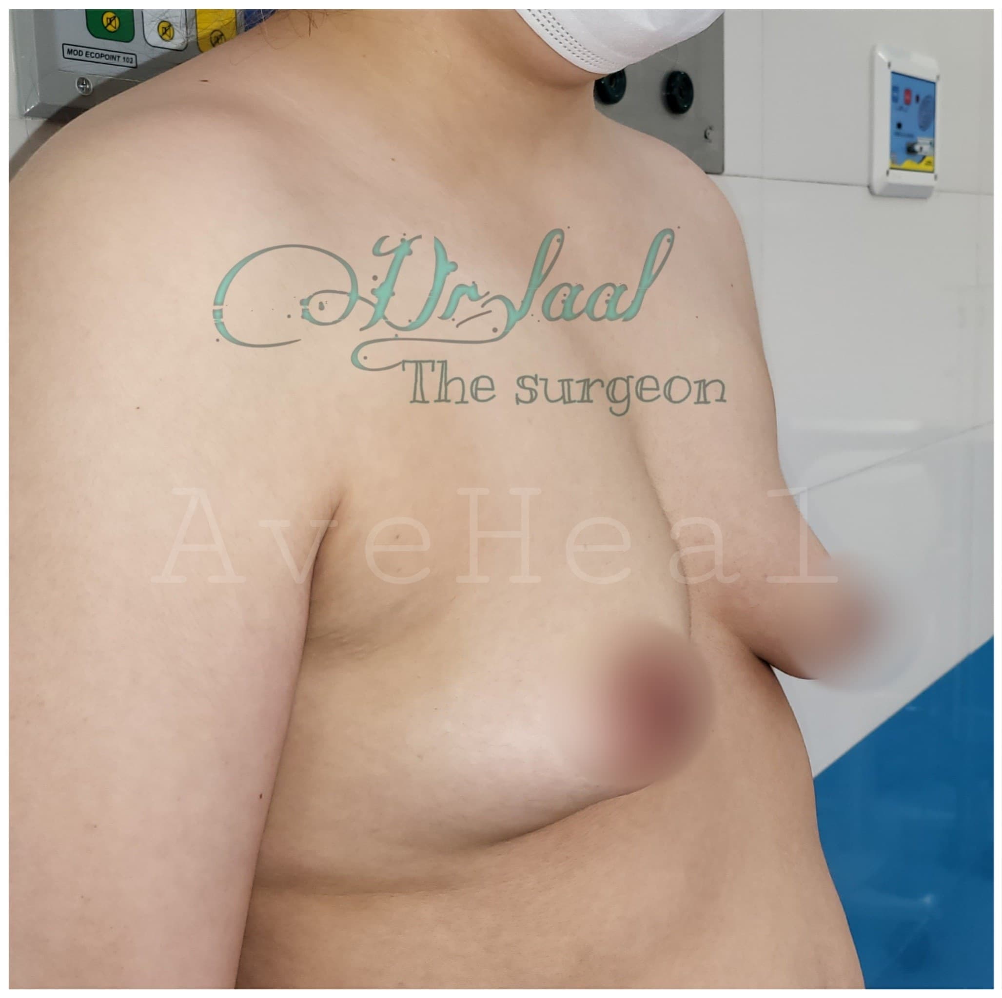 before-breast-lift-and-augmentation-dr-homeira-laal-khoshab